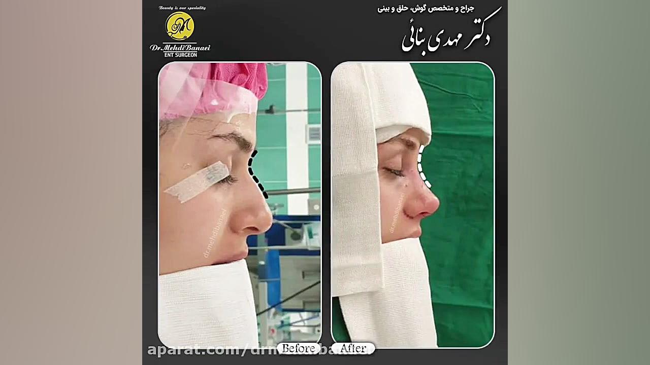 عمل زیبایی بینی استخوانی
