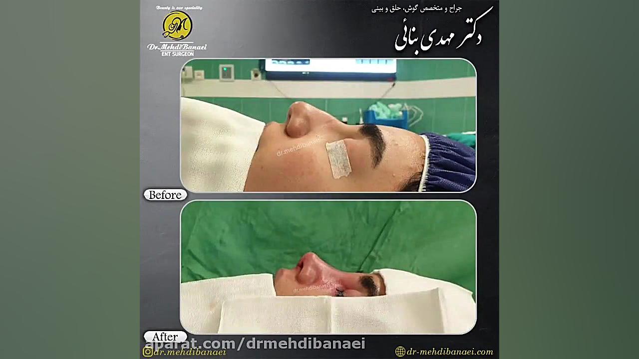 جراحی زیبایی بینی و رفع افتادگی نوک آن