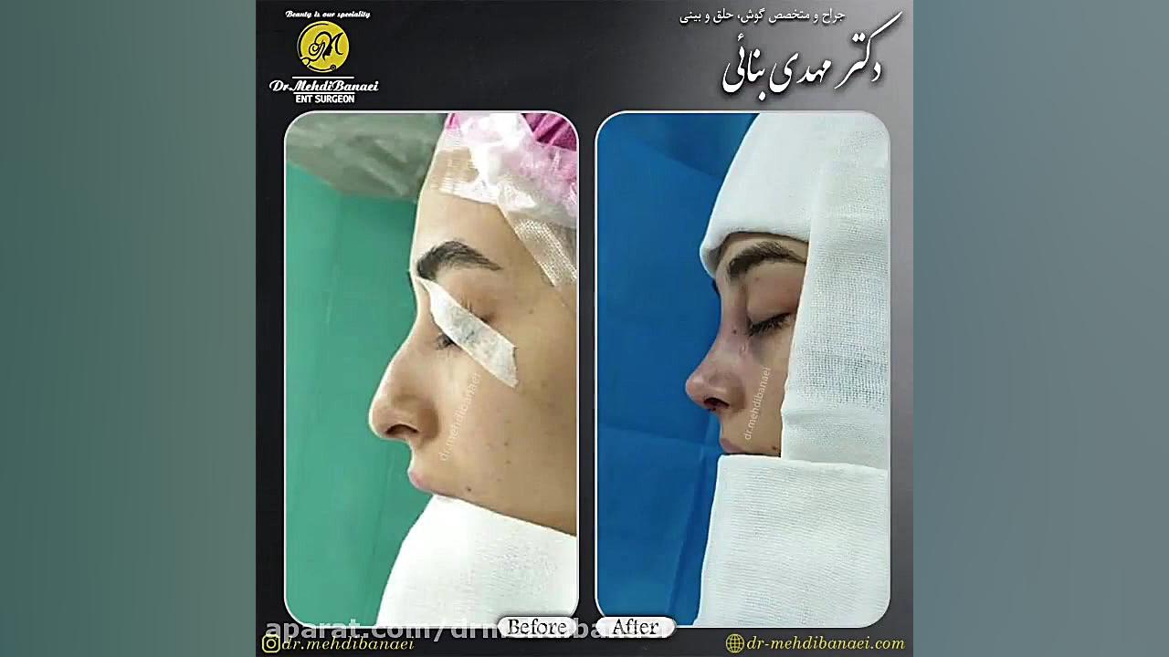فیلم جراحی زیبایی بینی