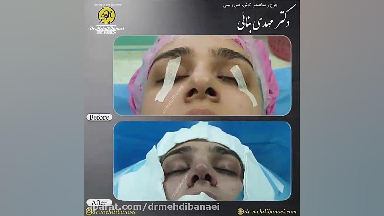 جراحی زیبایی بینی و رفع افتادگی نوک آن