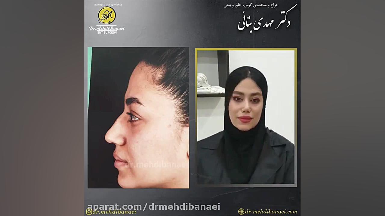 عمل زیبایی بینی و رفع افتادگی نوک آن