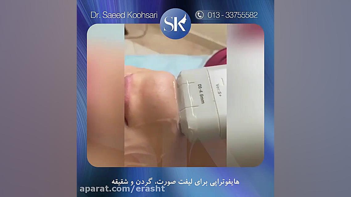 هایفوتراپی برای لیفت صورت، گردن و شقیقه ترومبوسیتوپنی مقاوم