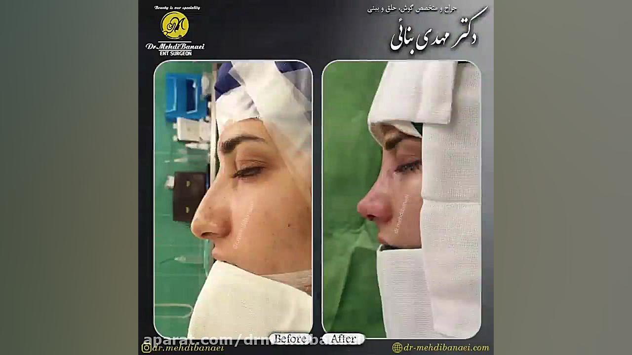 جراحی زیبایی بینی و رفع افتادگی نوک آن