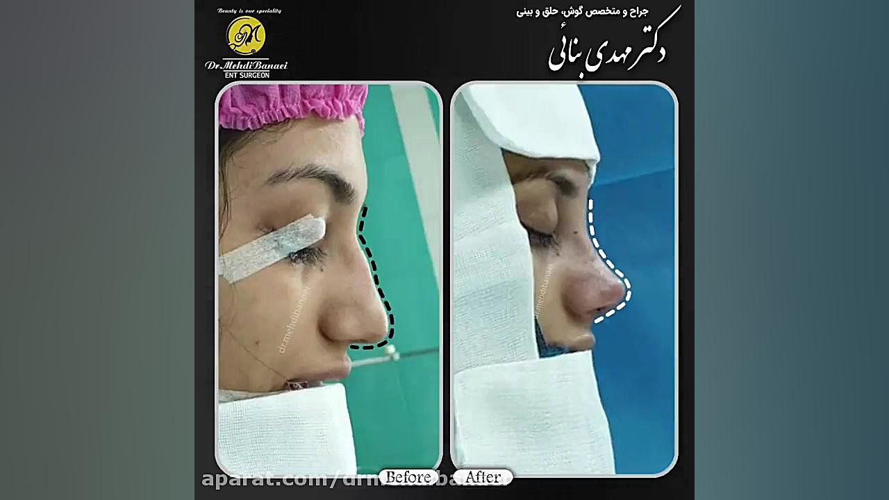 جراحی زیبایی بینی استخوانی و رفع قوز آن
