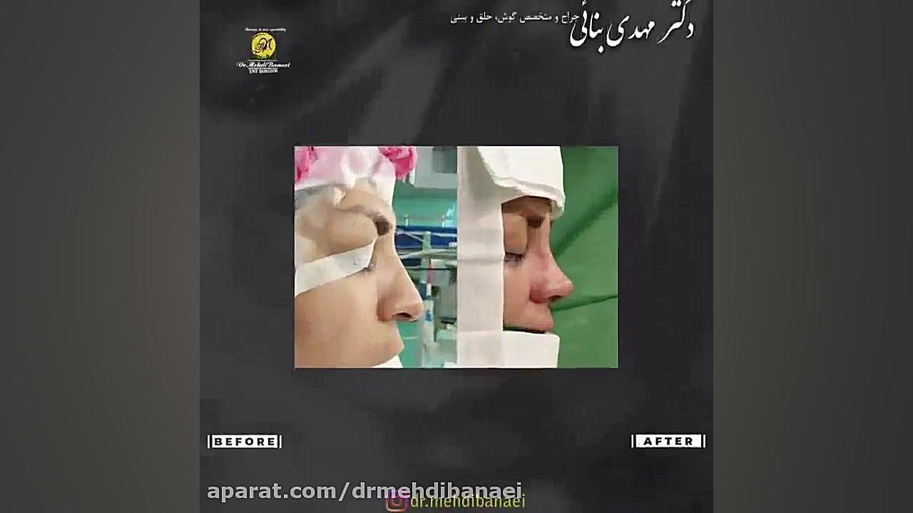 جراحی زیبایی بینی و رفع افتادگی نوک آن