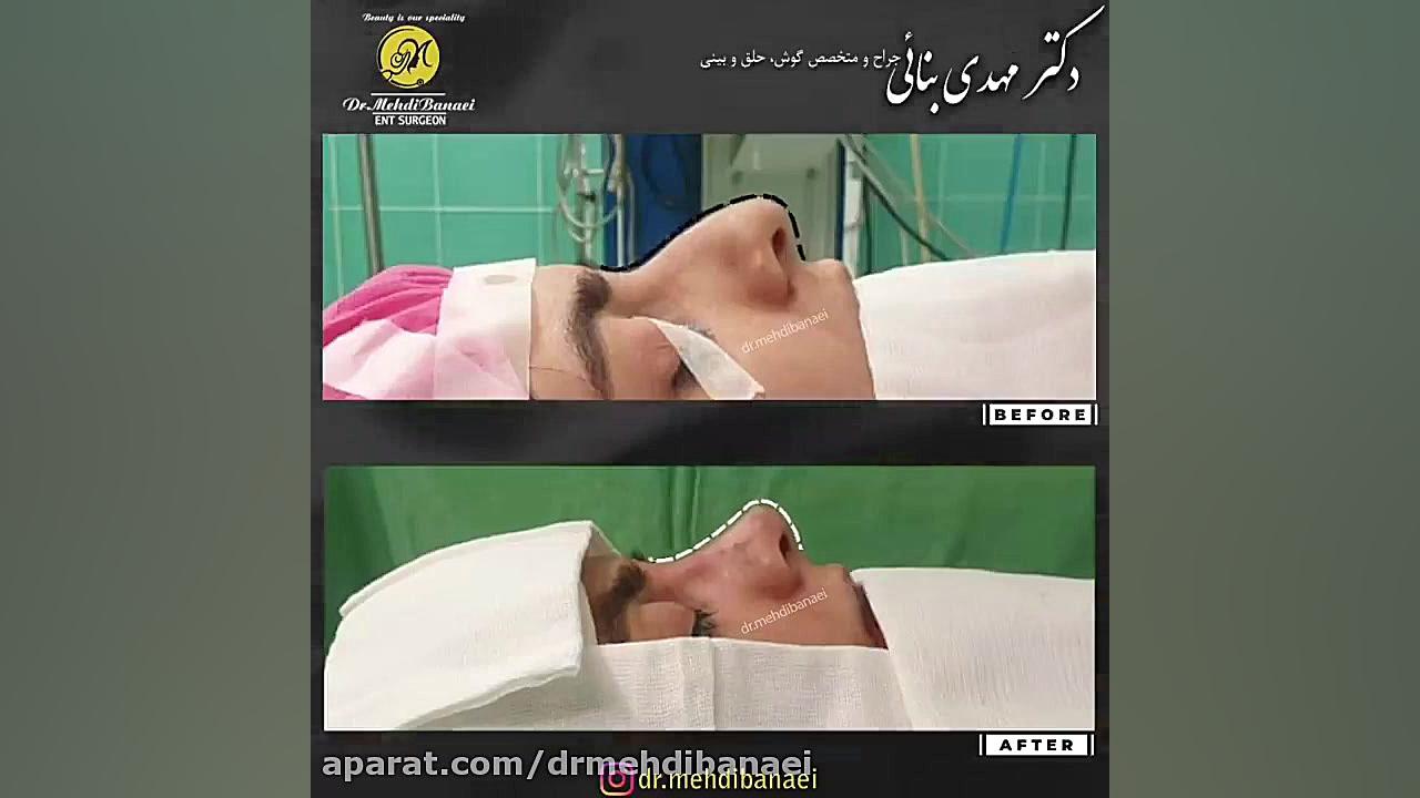 جراحی زیبایی بینی و رفع افتادگی نوک آن