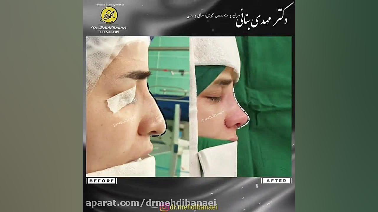 عمل زیبایی بینی