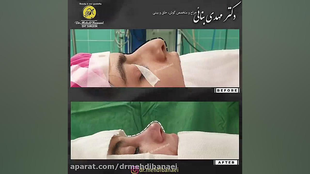جراحی زیبایی بینی و رفع افتادگی نوک آن