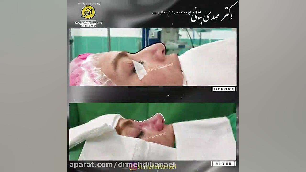 عمل زیبایی بینی