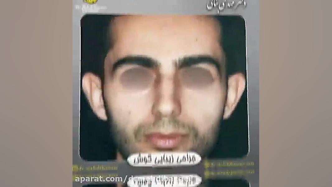 جراحی زیبایی گوش بیماری بهجت