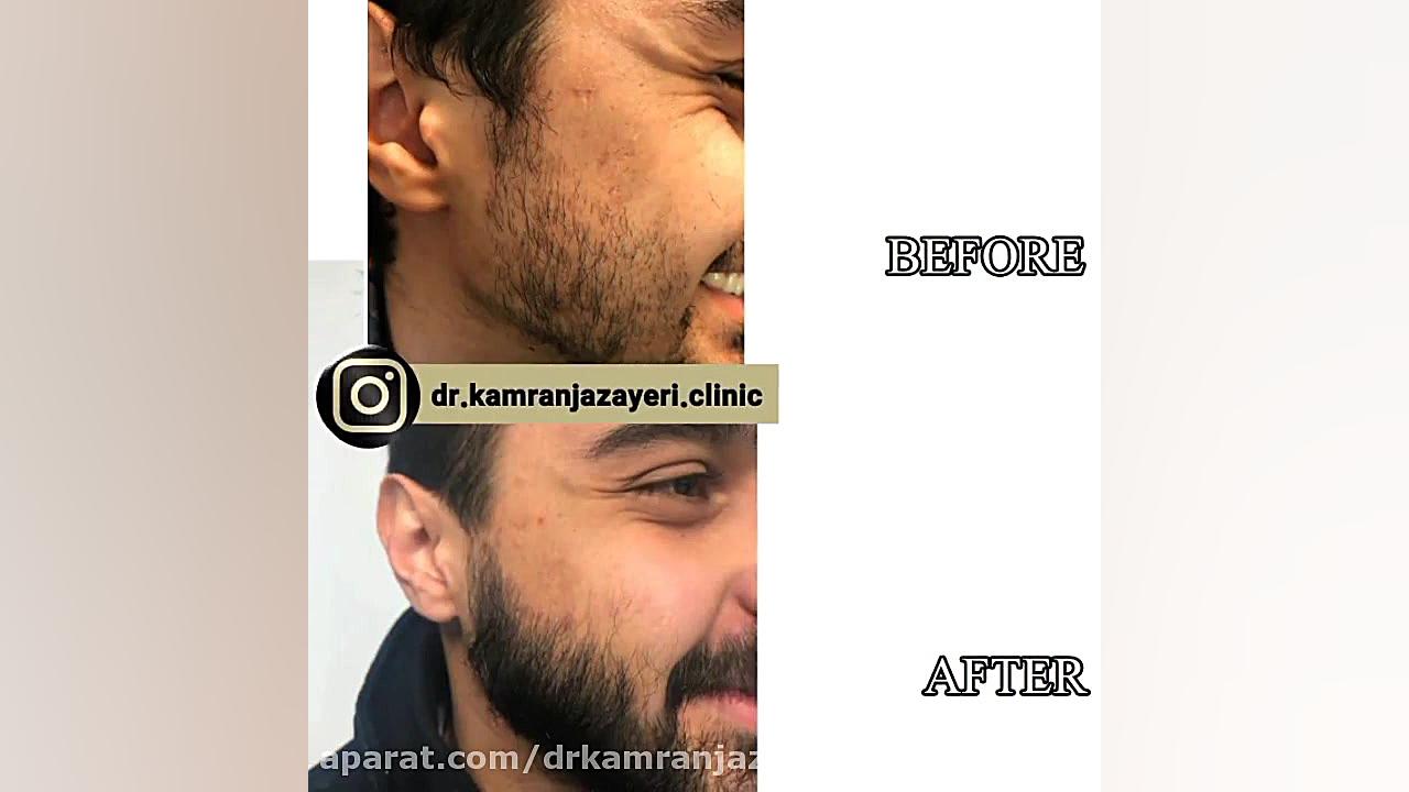 کاشت ریش ترومبوسیتوپنی مقاوم