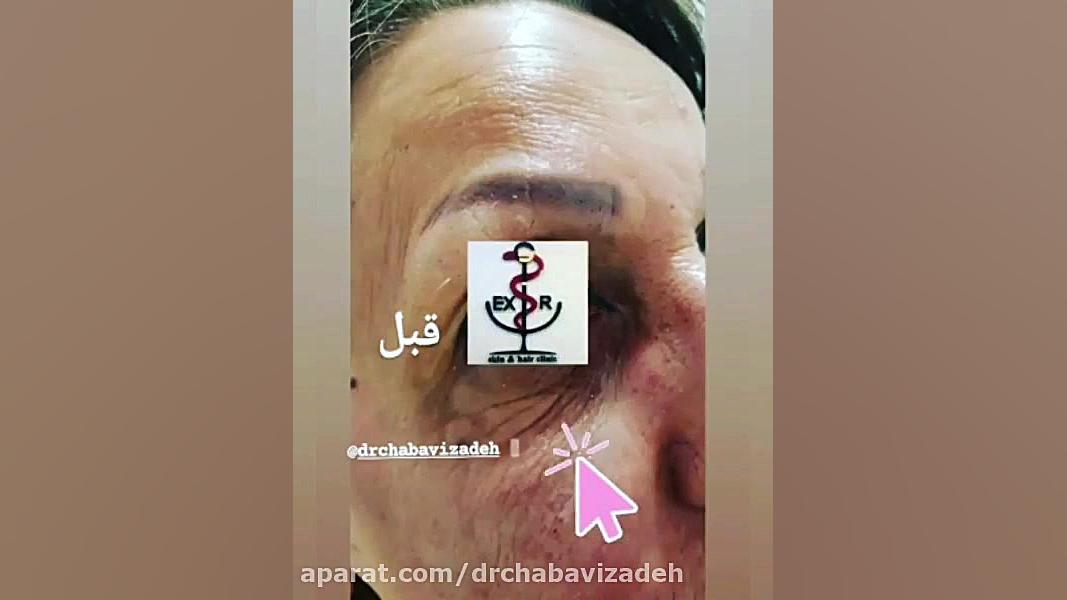 تزریق ژل زیر چشم دکتر چعباوی زاده دکتر صفیه چعباوی زاده