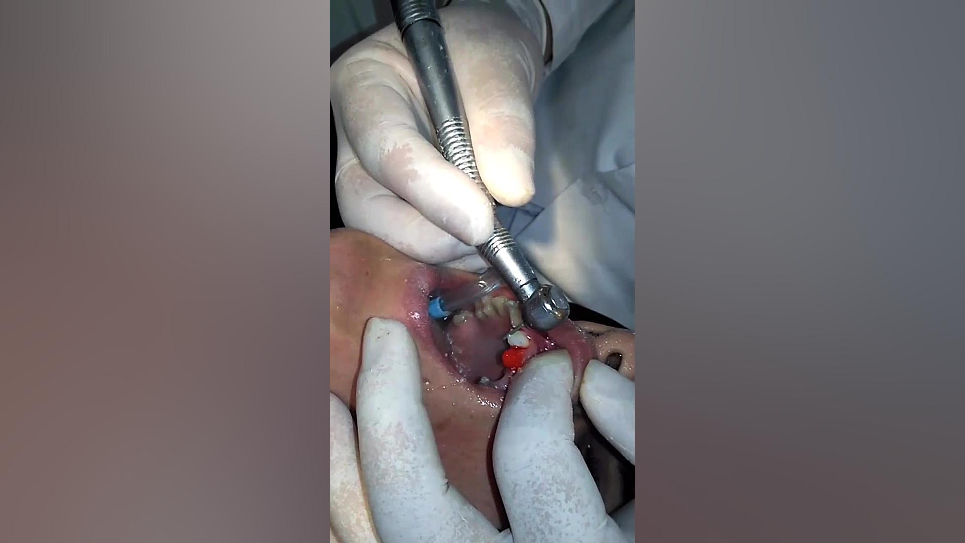 روکش دندان قدامی(ساخت پستوکور) اصلاح طرح لبخند