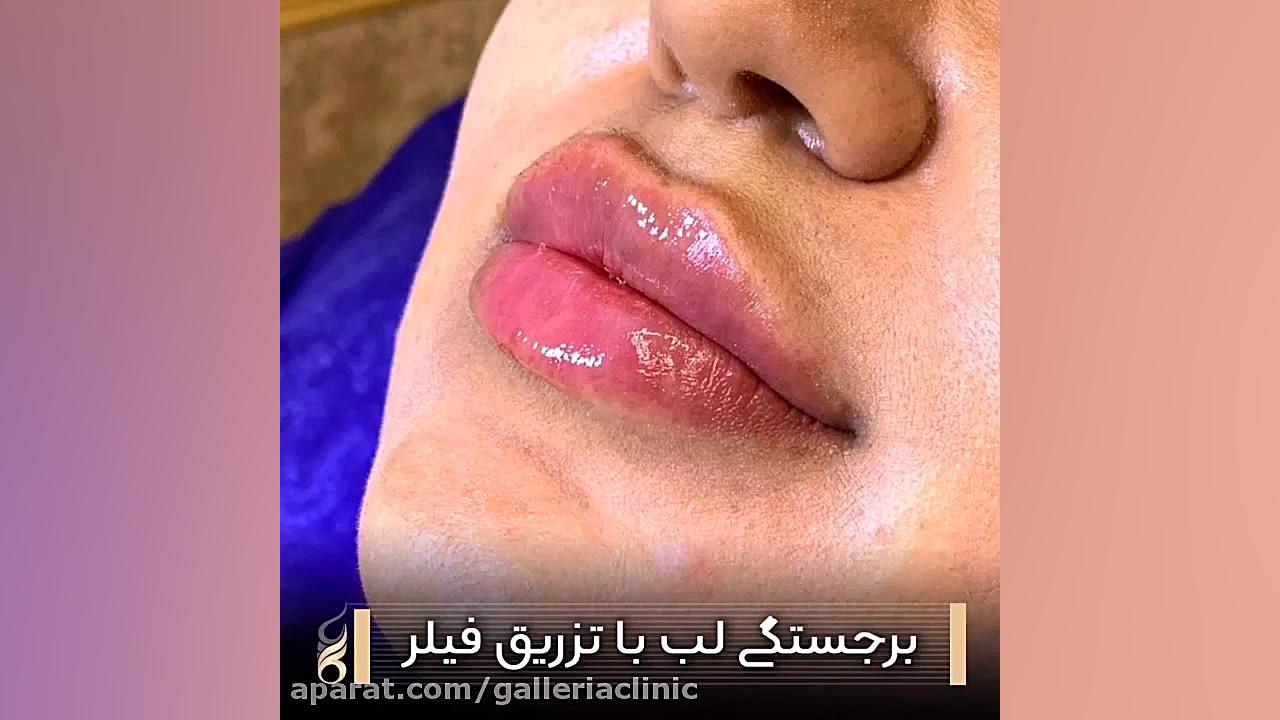 تزریق فیلر لب در مرکز زیبایی گالریا تالاسمی دلتا-بتا