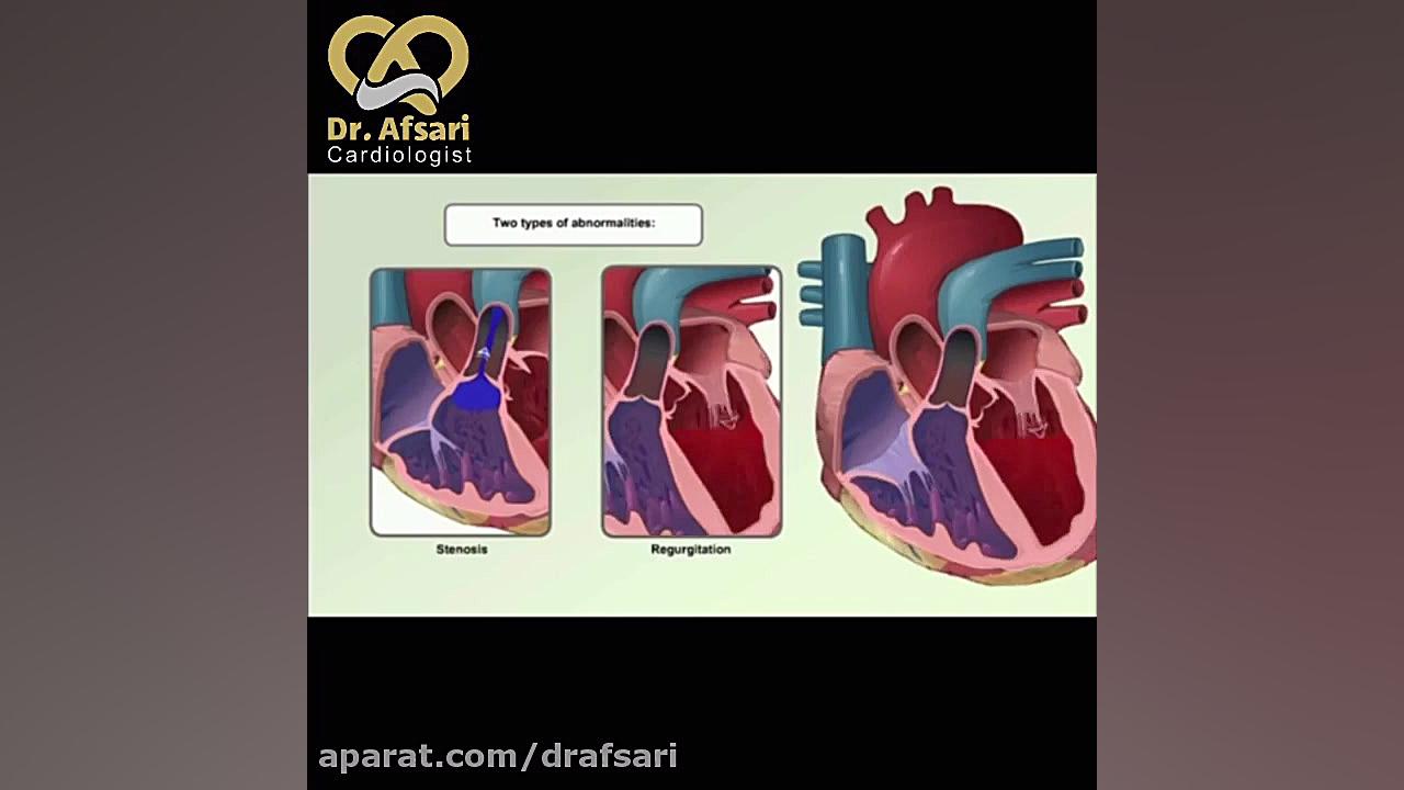 بیماری دریچه های قلب | دکتر یاسمین افسری متخصص قلب و عروق اکستنشن تاج دندان
