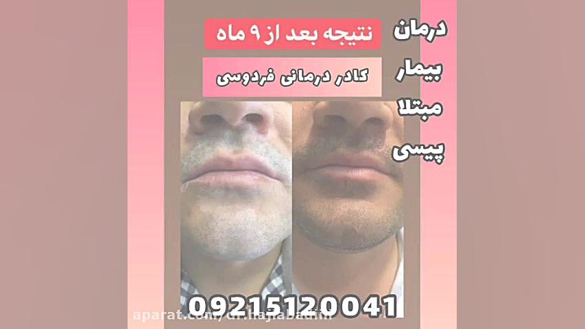 درمان تضمینی پیسی برص ویتیلیگو بدون عوراض در 8 ماه مارال فرجاد