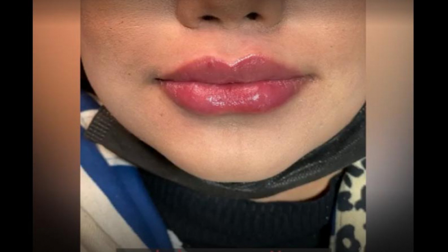 نتیجه تزریق ژل لب بیماری استئوجنز ایمپرفکتا