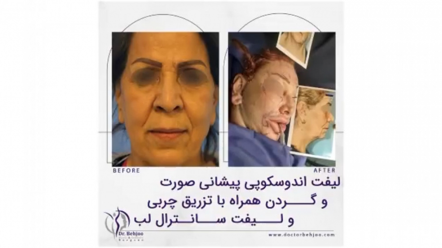 لیفت اندوسکوپی پیشانی صورت،گردن،همراه با تزریق چربی و سانترال لب دکتر شاهین بهجو - فوق تخصص جراحی پلاستیک