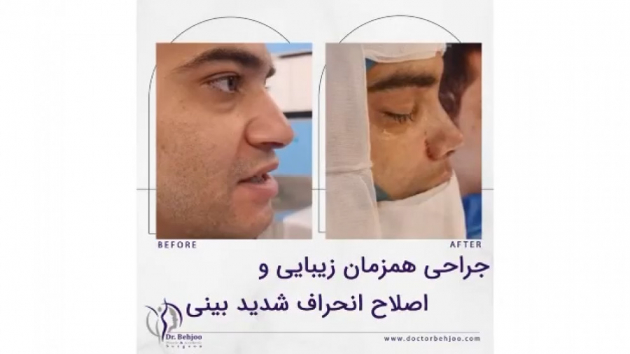 جراحی همزمان زیبایی و اصلاح انحراف شدید بینی دکتر شاهین بهجو - فوق تخصص جراحی پلاستیک