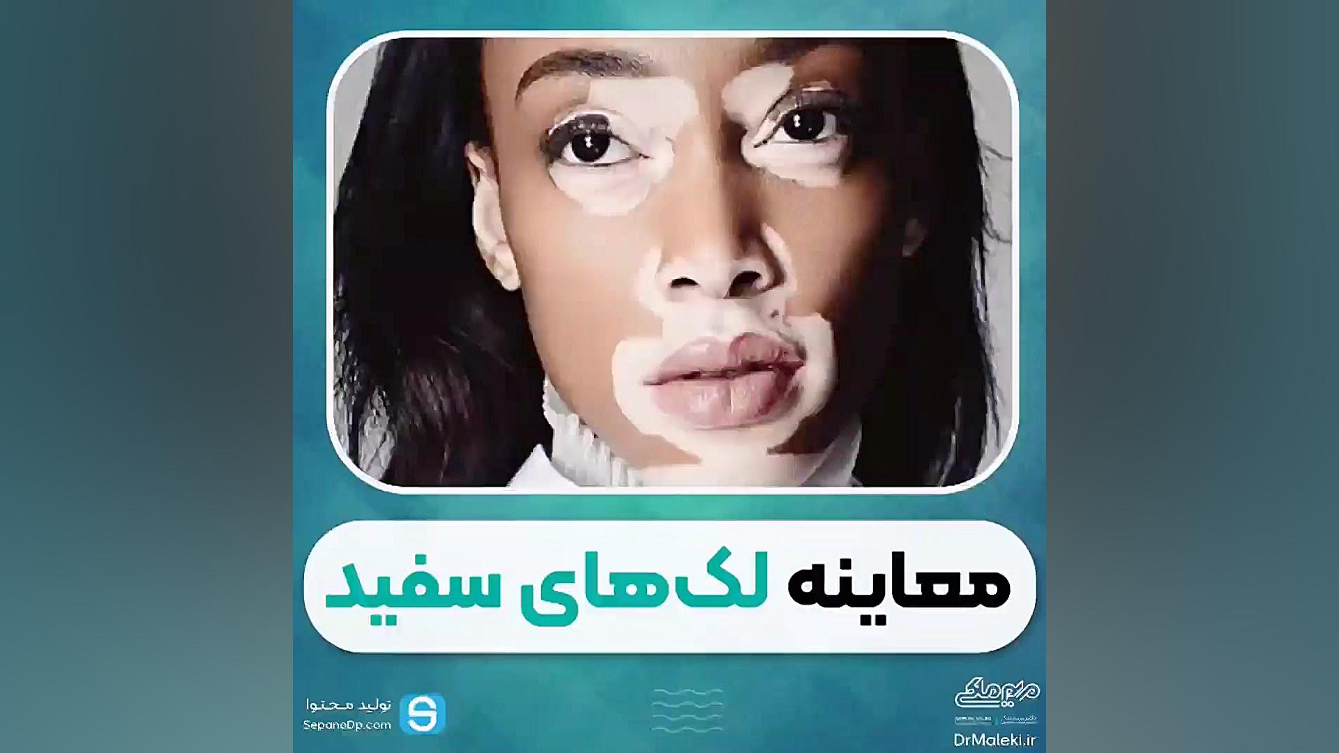 معاینه لکه های سفید پوستی دکتر مریم ملکی - کلینیک پوست و مو و زیبایی هور