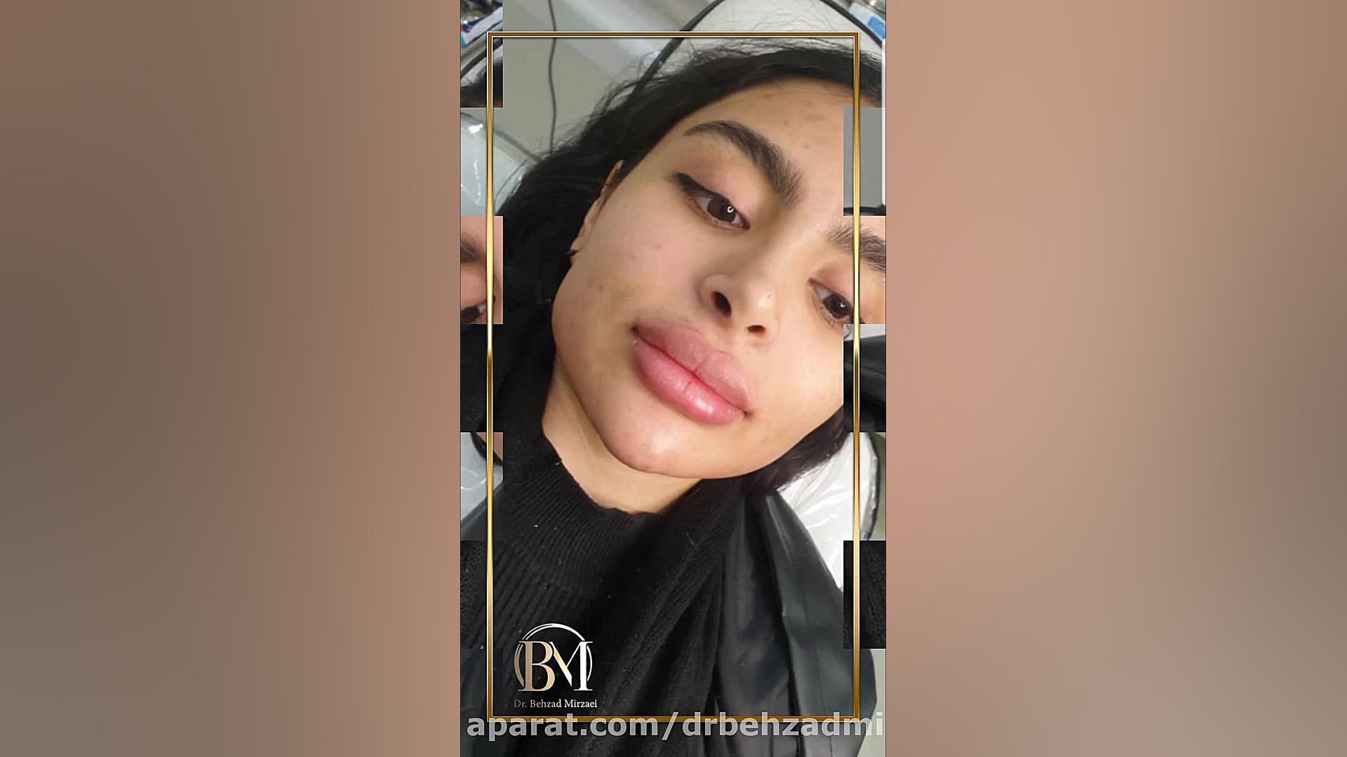 زاویه سازی فک و صورت سینتولاژوماب