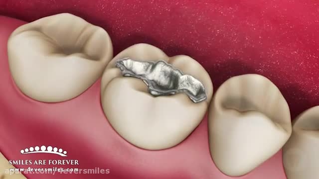 پر کردن دندان با آمالگام | درمان های دندانپزشکی پالبوسیکلیب