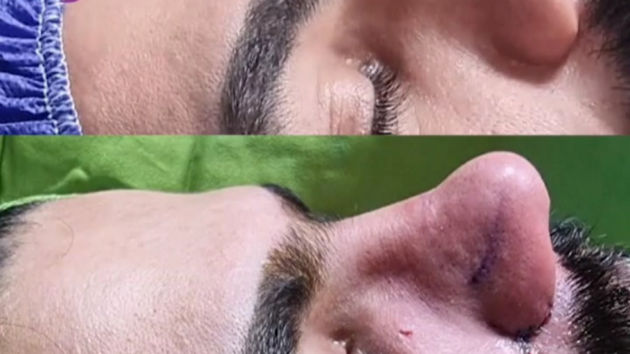 عمل بینی مردانه دکتر اسماعیل فرزاد فرد - فوق تخصص پلاستیک