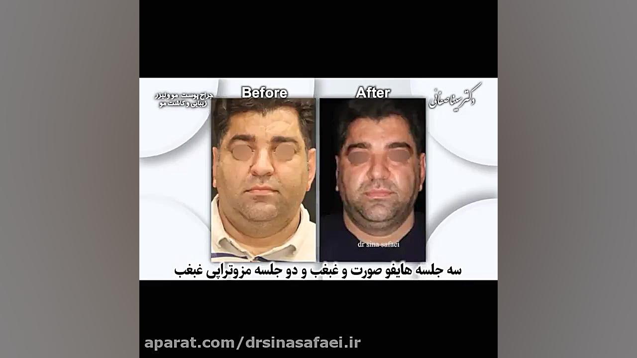 هایفوتراپی صورت و غبغب و مزوتراپی غبغب ANA