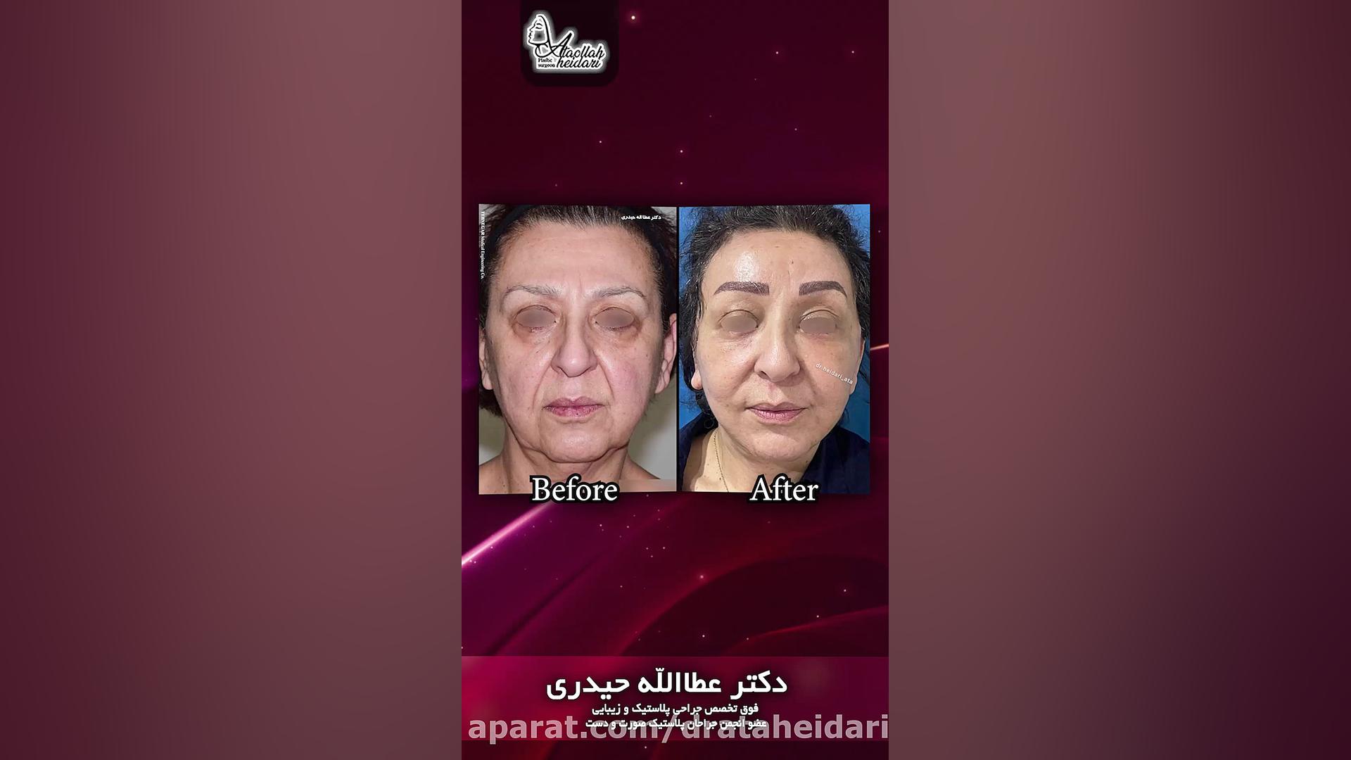 لیفت صورت ، پیشانی و گردن و بلفاروپلاستی تحتانی و تزریق چربی رادیوگرافی دندان