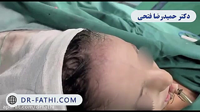فیلم بازسازی گونه دکتر حمید رضا فتحی فوق تخصص جراحی پلاستیک