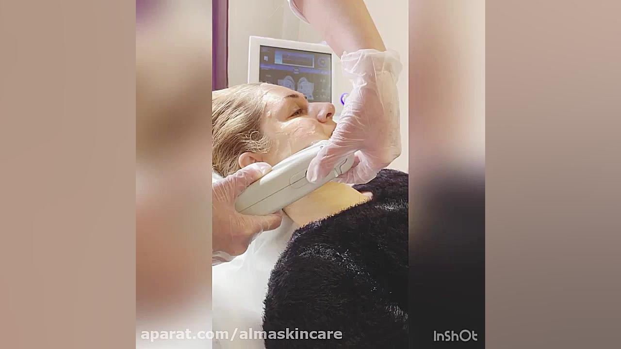 هایفوتراپی : لیفت صورت در بهترین کلینیک زیبایی در رشت کلونینگ درمانی