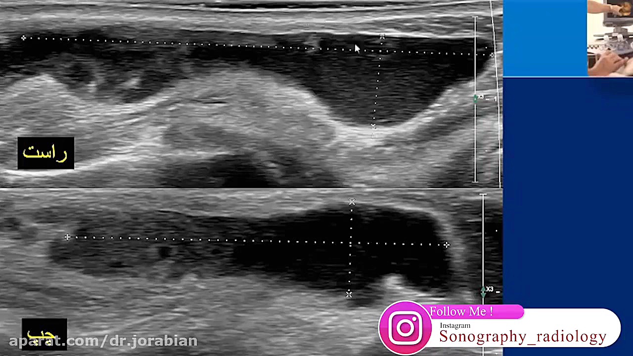 نقش سونوگرافی در تشخیص ژل های تزریقی ترمیم سوختگی