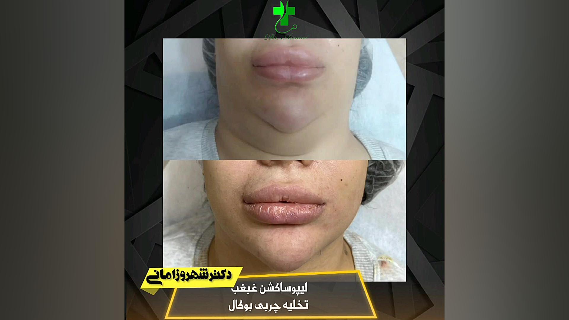 لیپوساکشن غبغب تخلیه چربی بوکال سنسور فشار اینتراوسکولار