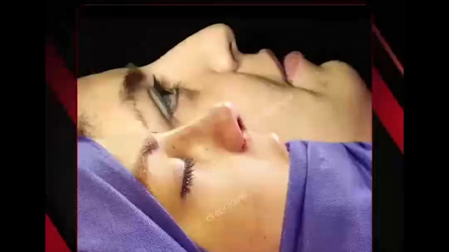 جراحی بینی گوشتی توسط دکتر امید ابراهیمی بهترین جراح بینی در تهران دکتر امید ابراهیمی