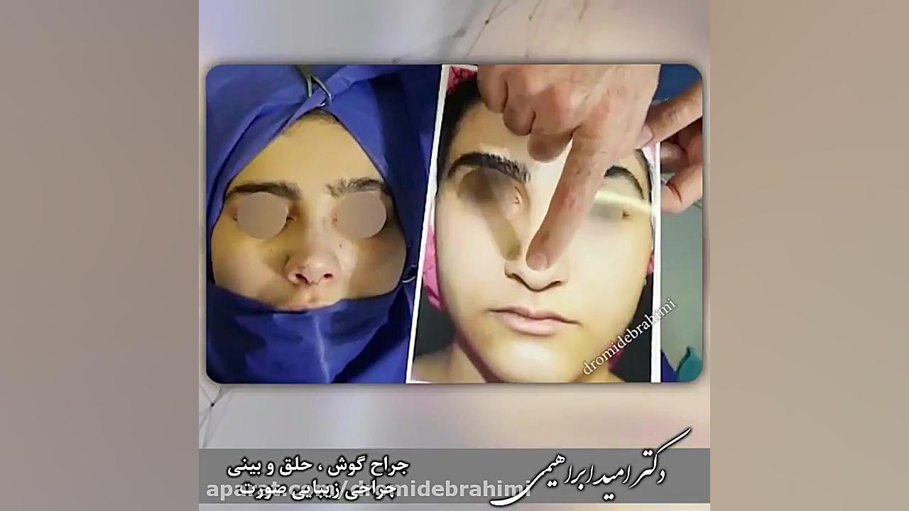 عمل بینی استخوانی با قوز و افتادگی نوک توسط دکتر امید ابراهیمی بهترین جراح بینی دکتر امید ابراهیمی