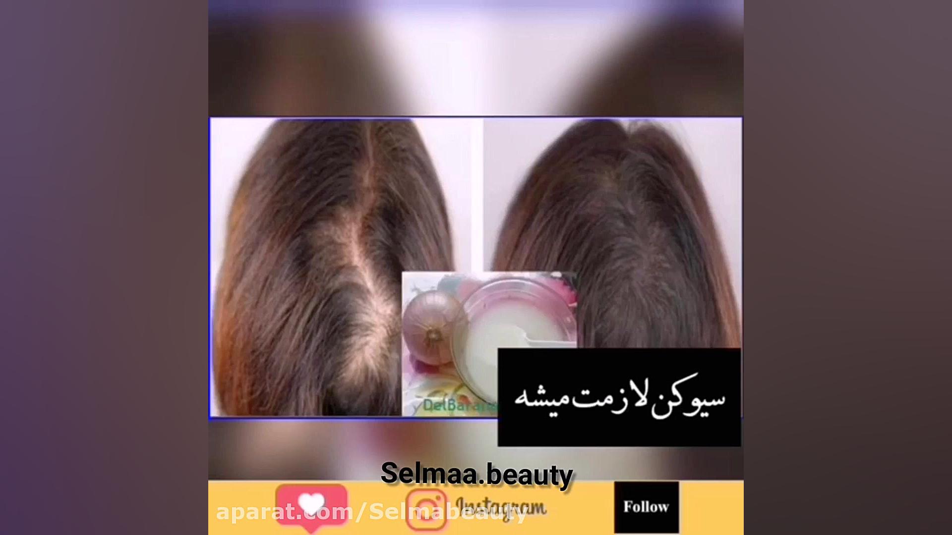 درمان ریزش مو و طاسی سر درمان ریزش مو