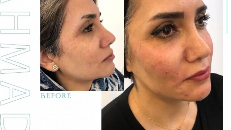فرم دهی و زاویه سازی صورت با تزریق چربی دکتر سوسن احمدی پیر شهید