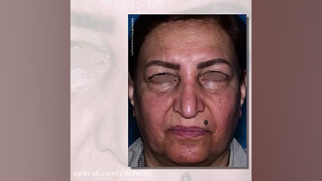 فیلم اتاق عمل بلفاروپلاستی و لیفت اندوسکوپی ابرو دکتر حمید رضا فتحی فوق تخصص جراحی پلاستیک