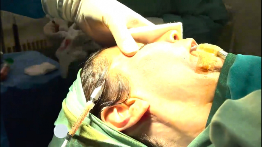 فیلم واقعی تزریق چربی به صورت دکتر حمید رضا فتحی فوق تخصص جراحی پلاستیک