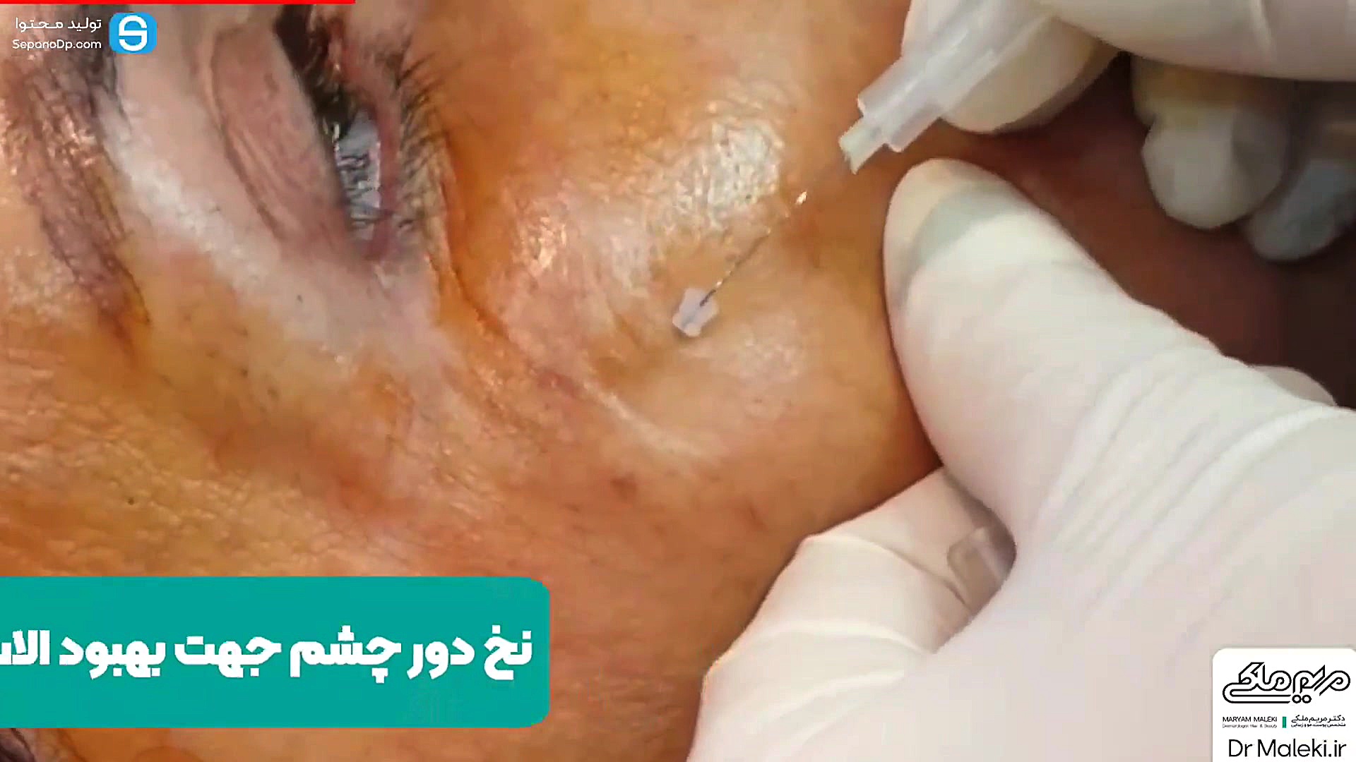 نخ دور چشم جهت بهبود الاستیسیته پوست دکتر مریم ملکی - کلینیک پوست و مو و زیبایی هور