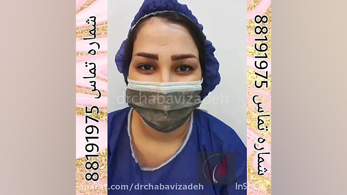 کاشت سه بعدی و سوپر نچرال ابرو دکتر صفیه چعباوی زاده