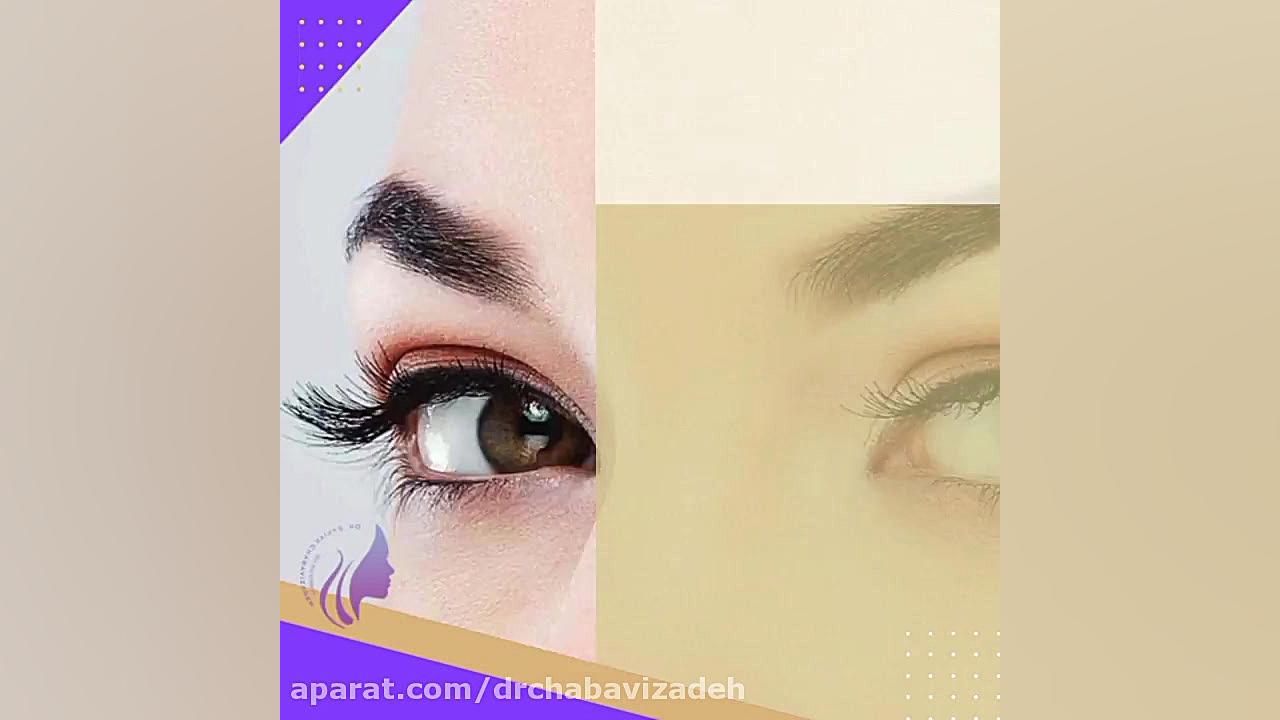 مراقبت های قبل و بعد کاشت ابرو دکتر صفیه چعباوی زاده