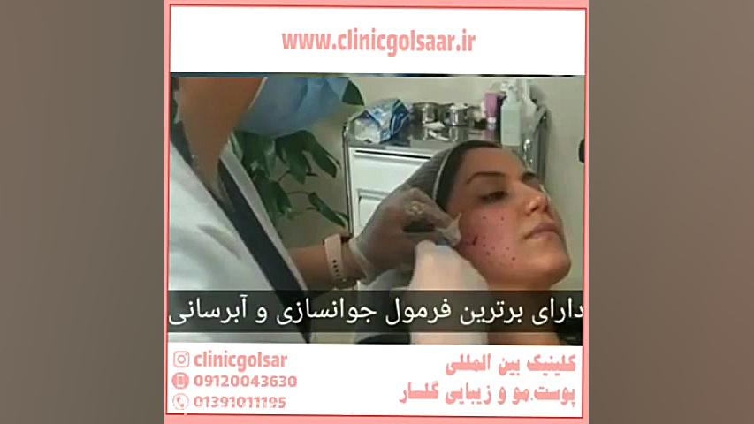 جوانسازی پوست صورت با لیزر آر آف فرکشنال منافذ باز پوست