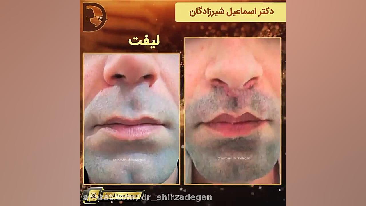 لیفت لب دکتر اسماعیل شیرزادگان