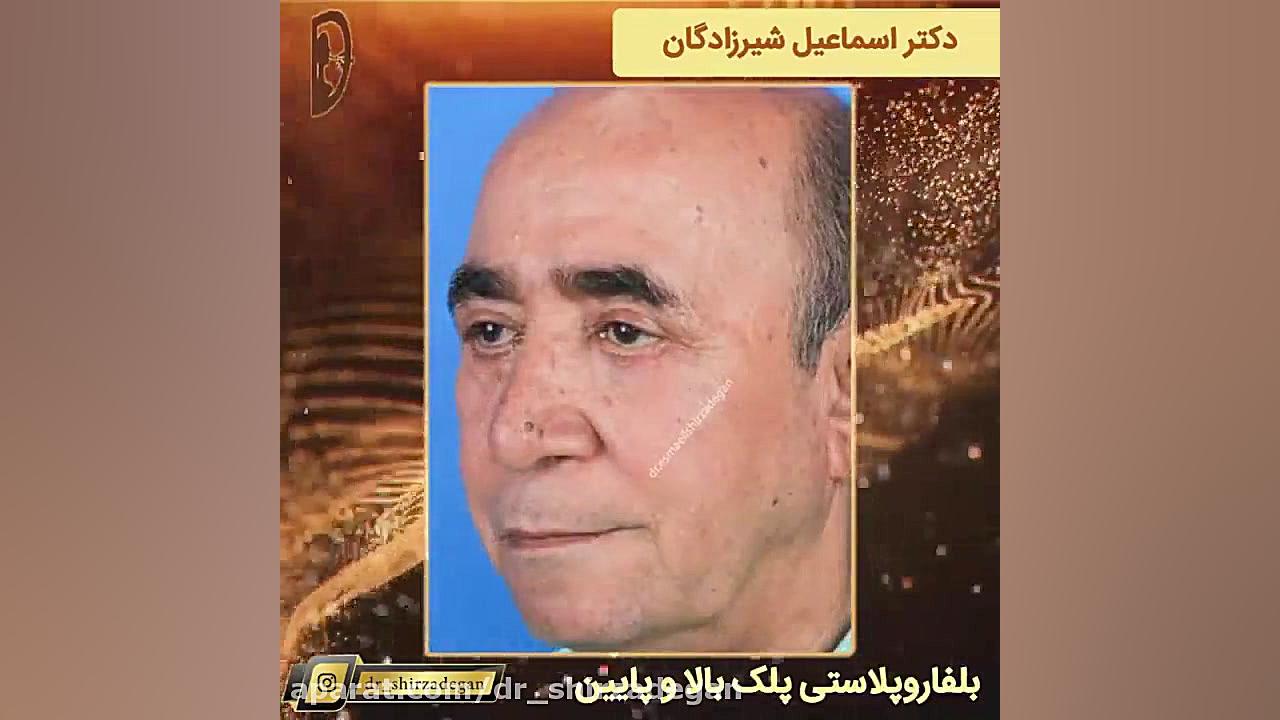 بلفاروپلاستی پلک بالا و پایین دکتر اسماعیل شیرزادگان