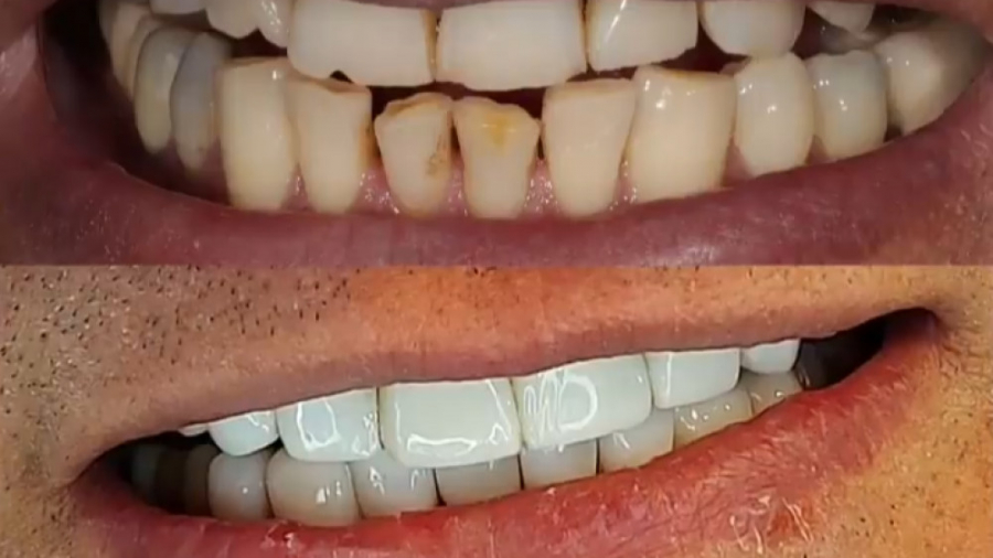 نمونه انجام کامپوزیت ونیر به رنگ بیلیچ برای بیمار محترم دندان پیش