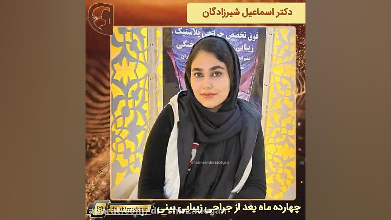 چهارده ماه بعد از جراحی زیبایی پلک دکتر اسماعیل شیرزادگان