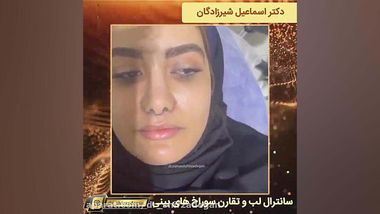 سانترال لب و تقارن سوراخ های بینی دکتر اسماعیل شیرزادگان