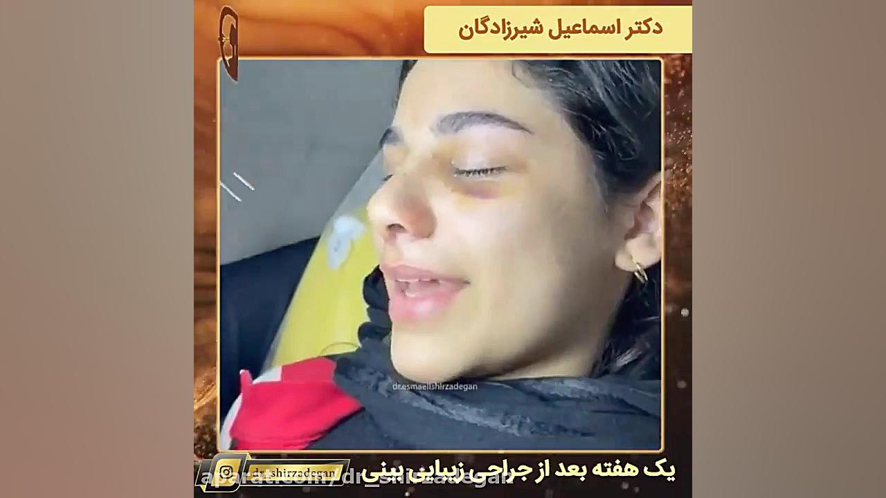 یک هفته بعد از جراحی زیبایی بینی دکتر اسماعیل شیرزادگان