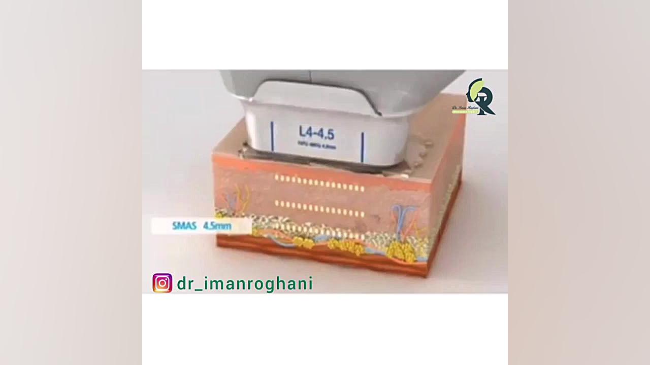 انیمیشن کامل هایفوتراپی دکتر ایمان روغنی جراح و متخصص پوست و مو